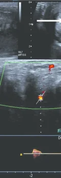 Colour-Doppler