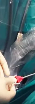 سنگ شکنی