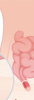 inguinal hernia