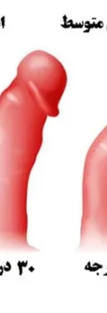 penile-curvature1