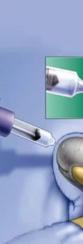 surgicalspermretrieval500x5001_1631179610_main