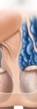 varicocele